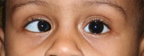 _161_strabismus1.jpg