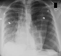 Left tension pneumothorax.