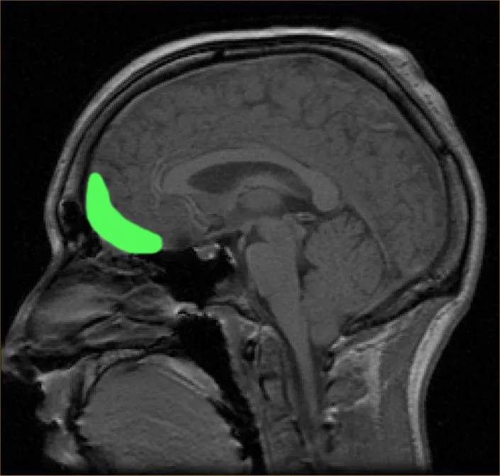MRI_of_orbitofrontal_cortex.jpg