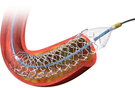 Paclitaxel-eluting Stent.png