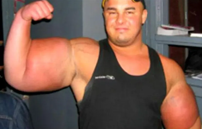 830x532_synthol-plein-bras.jpg