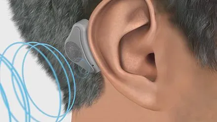 Bone Conduction Hearing Devices.jpg
