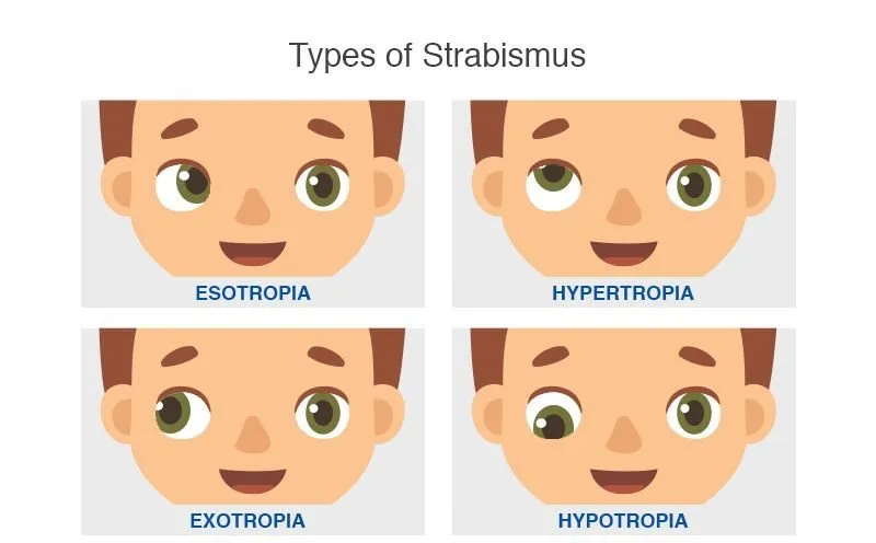 strabismus