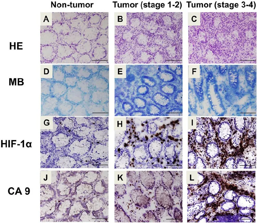 Histological-and-immunohistochemical-analysis-for-hypoxia-and-CA9-expression-in-human.png