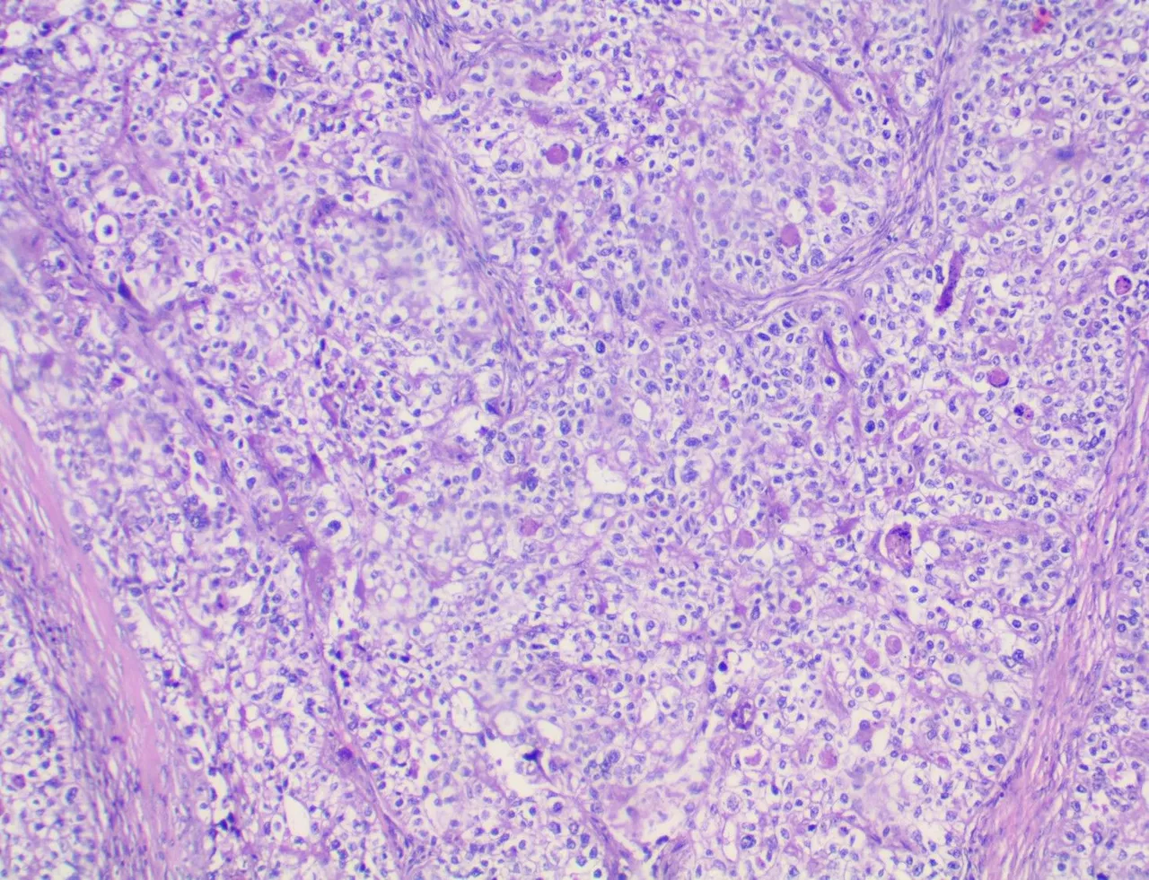 Clear Cell Carcinoma of the Ovary LPF.jpg