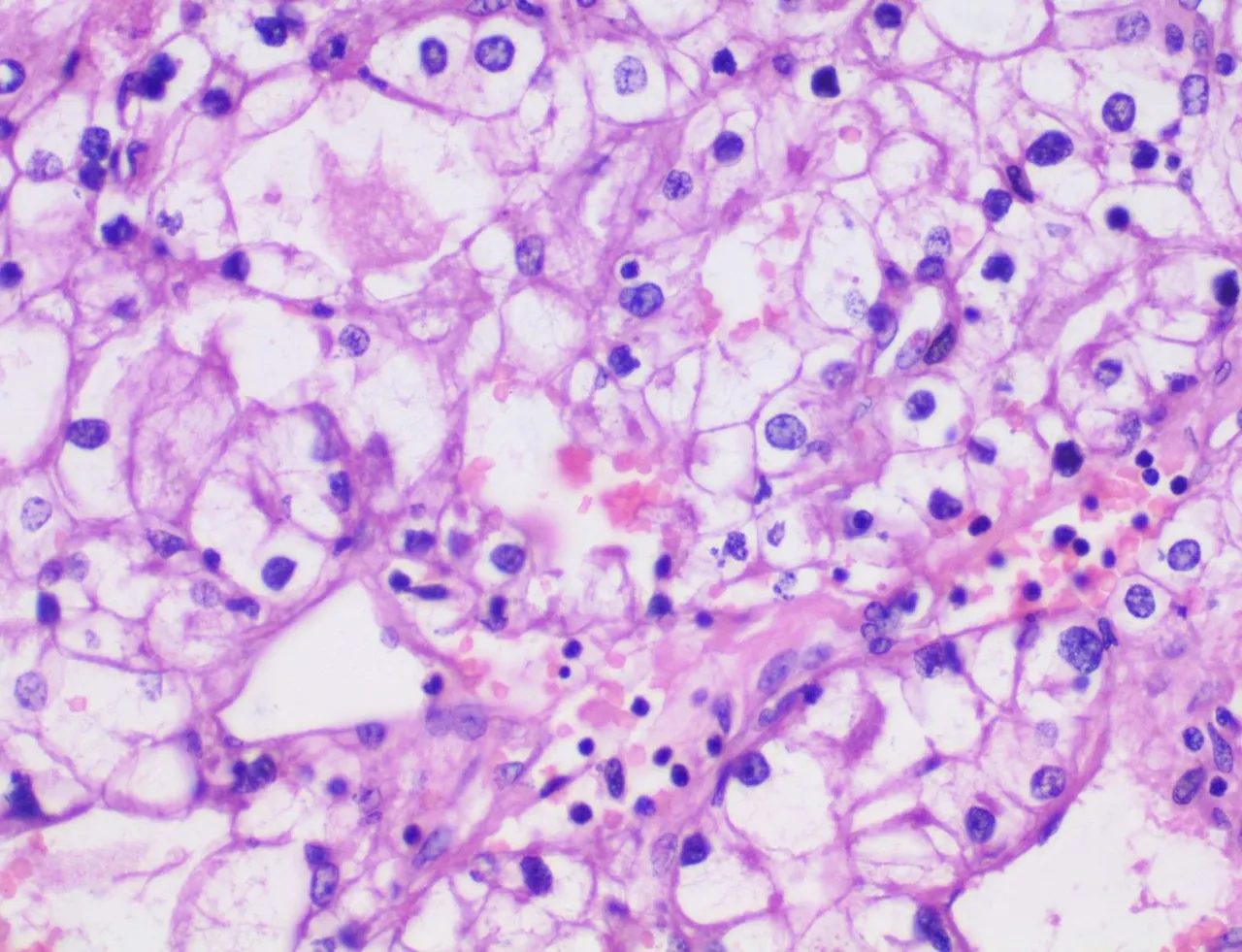 Renal Clear Cell Carcinoma HPF.jpg