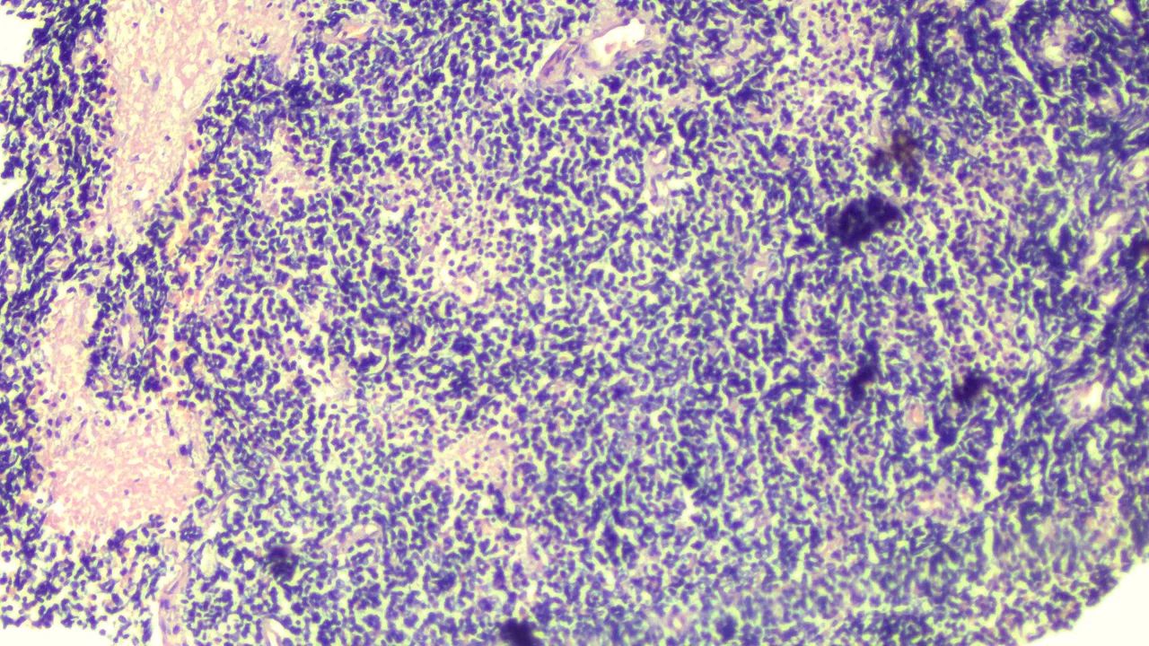 Pineoblastoma LPF 1.png