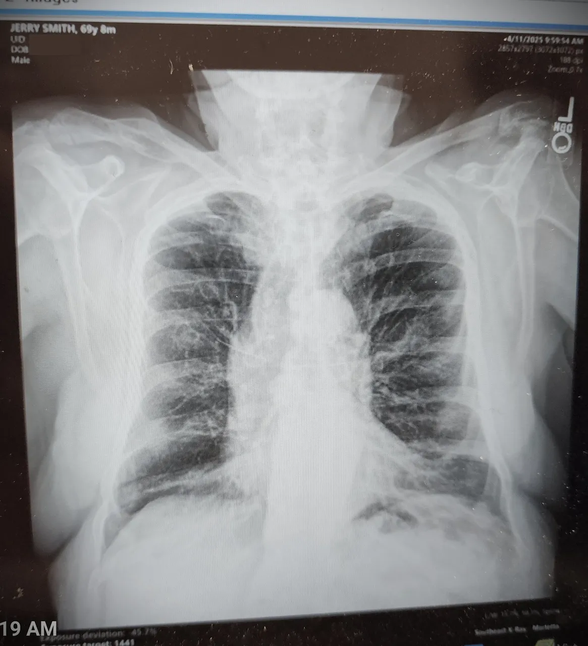 Lungs clean of numbers.jpg