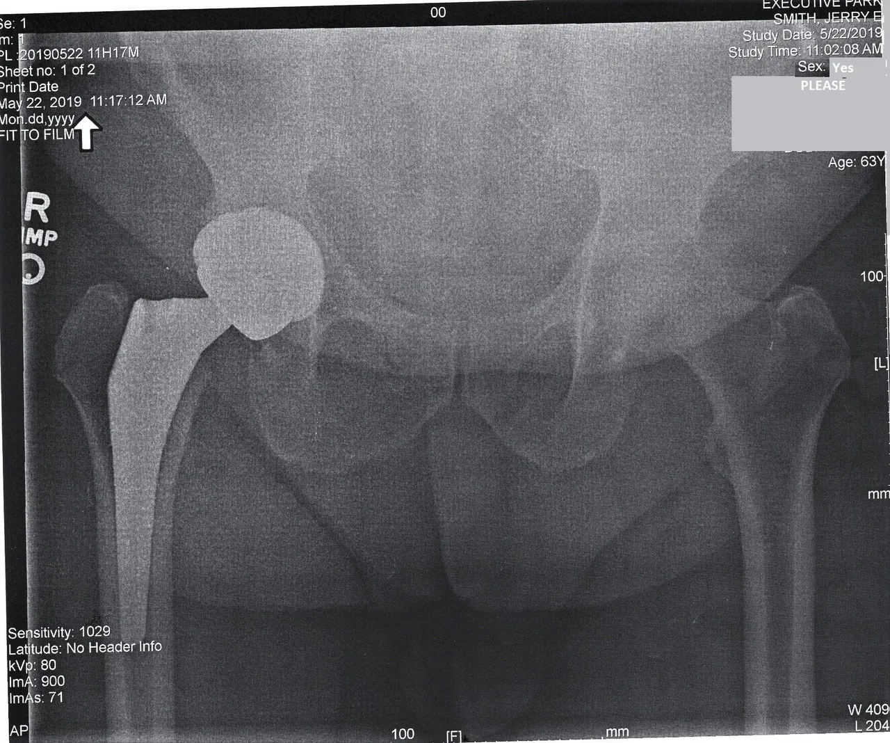 New Hip 1_cleaned.jpg