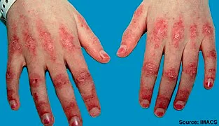 313px-Dermatomyositis2.jpg