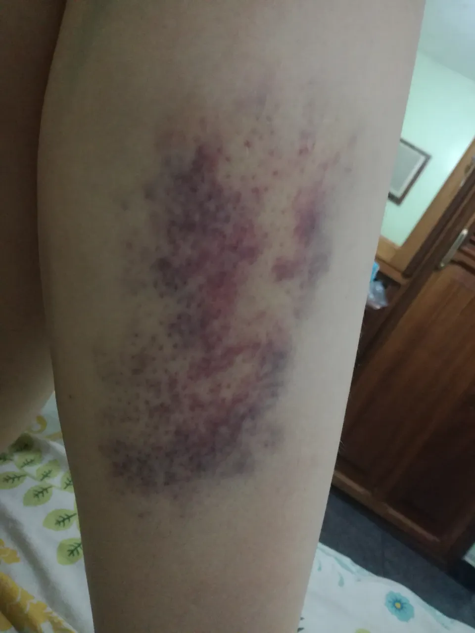 hematoma.jpg