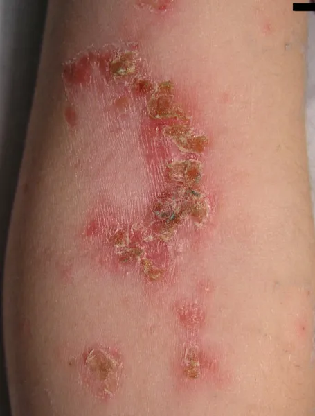 Impetigo_elbow.jpg