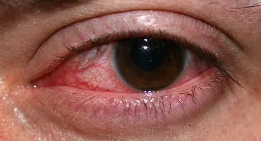 Optic-Neuritis.jpg