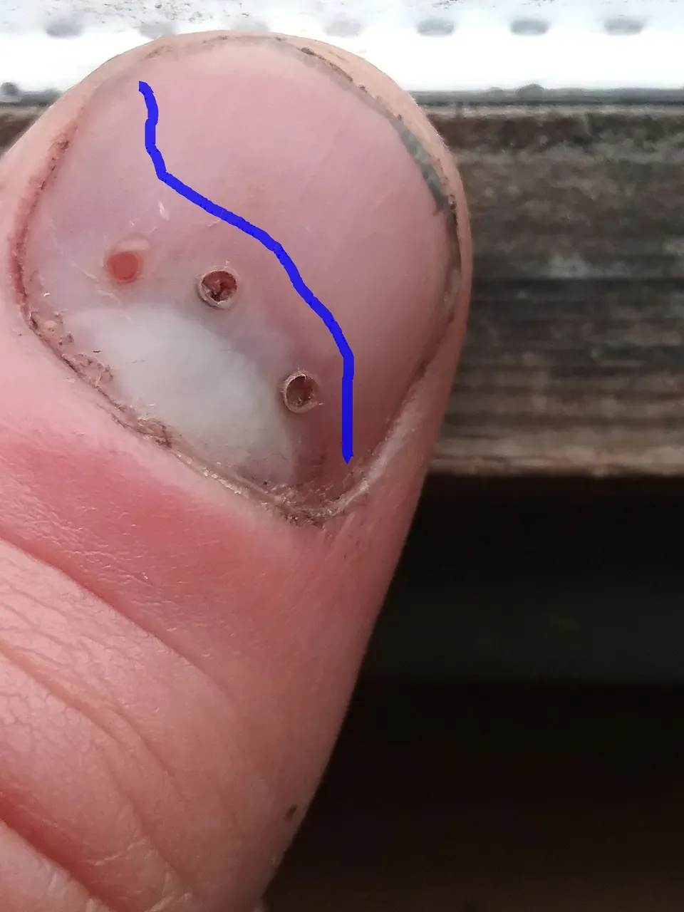area of bruise.jpg