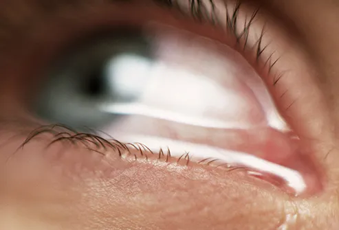 493ss_getty_rf_watery_eye.jpg