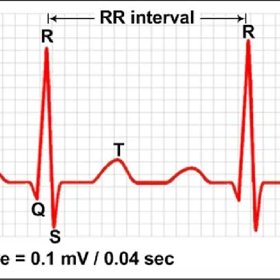 Illustration-of-QRS-complexes-and-RR-interval-of-ECG-signals_Q640.jpg