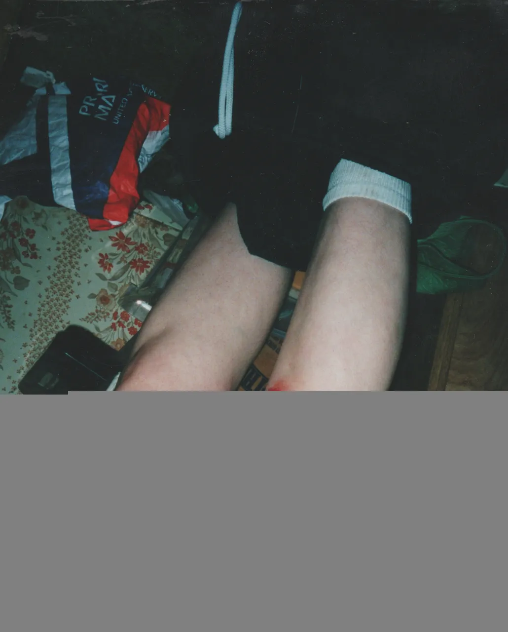 2001-12-06 - Legs Injured - Wound - Maybe Katie.jpg