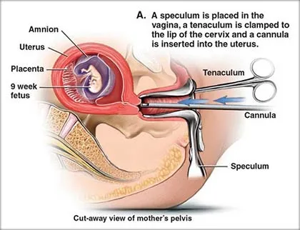 Surgical-Abortion.jpg